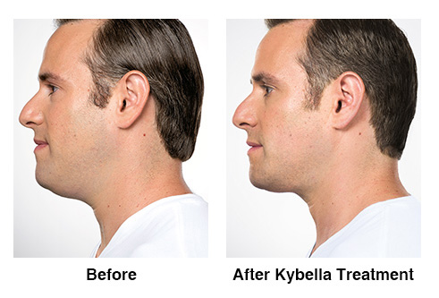 Kybella_Before_and_After_1