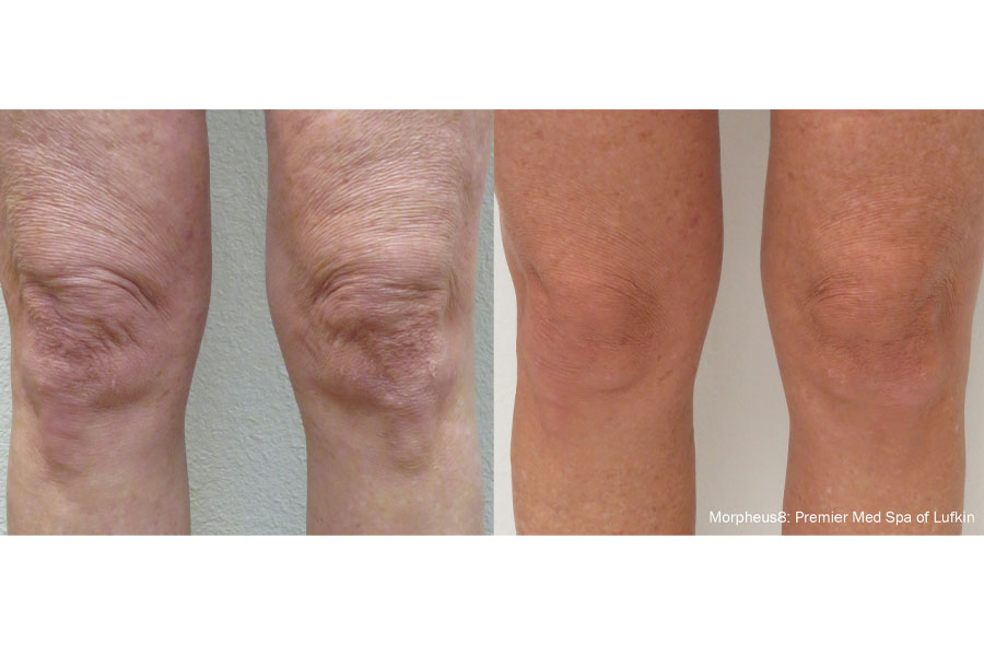 morpheus8-before-after-Knees-(1)