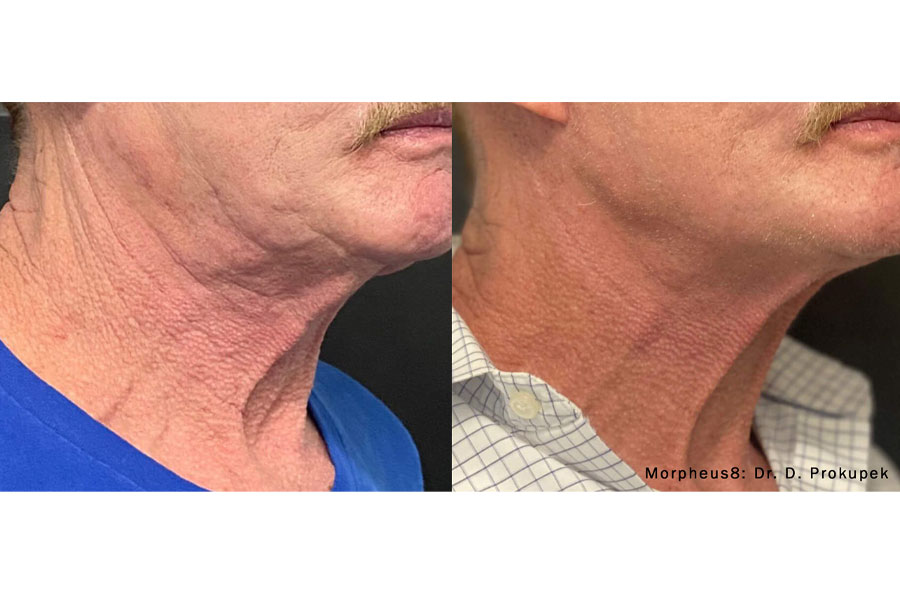 morpheus8-before-after-Male-NECK-1