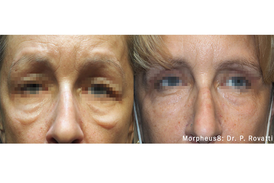 morpheus8-prime-before-after-EYES