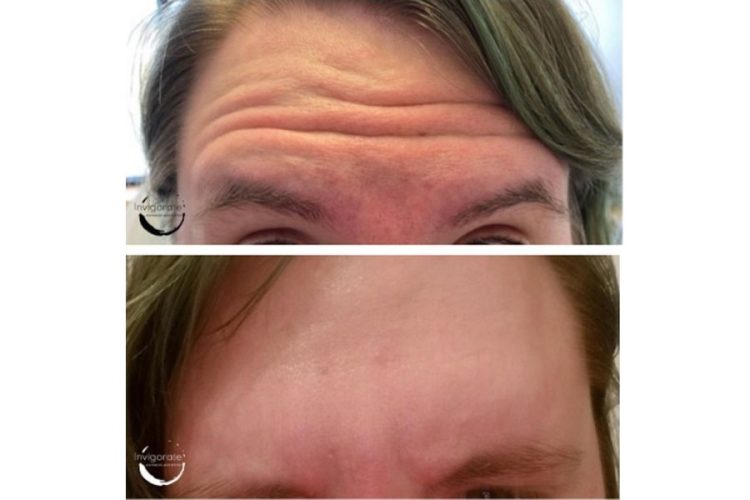 Botox-Forhead---In-Office-Before-and-After-Pic