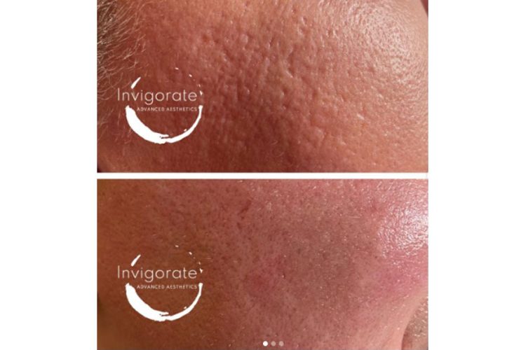 CO2-Laser-Acne-Scar-Correction-Before-and-After