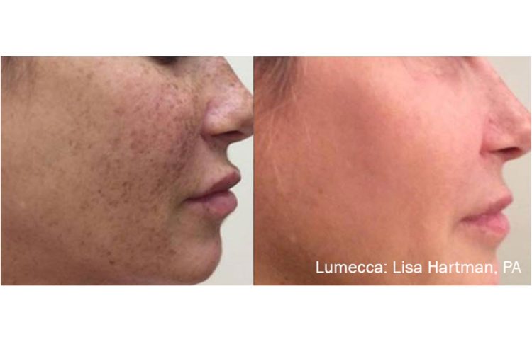 lumecca-before-after-Face-Freckles